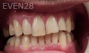 Sami-Hersel-Dental-Bonding-before-3