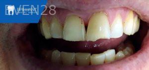 Sami-Hersel-Dental-Bonding-before-4