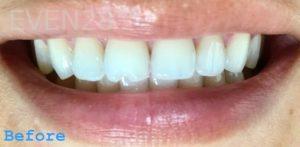 Sami-Hersel-Dental-Bonding-before-5