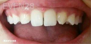 Sami-Hersel-Dental-Bonding-before-6