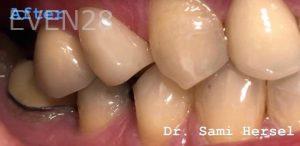 Sami-Hersel-Dental-Crowns-after-2