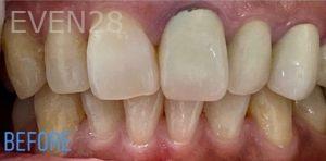 Sami-Hersel-Dental-Crowns-before-1
