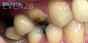 Sami-Hersel-Dental-Crowns-before-2