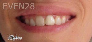 Sami-Hersel-Dental-Crowns-before-3