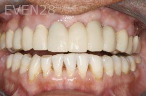 Sandro-Tomita-Dental-Implants-after-1