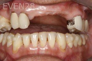 Sandro-Tomita-Dental-Implants-before-1