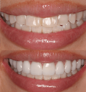 Smile-Makeover-before-after