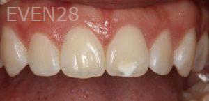 Sydon-Arroyo-Dental-Bonding-before-1
