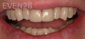 Sydon-Arroyo-Dental-Crown-after-1