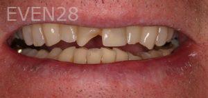 Sydon-Arroyo-Dental-Crown-before-1