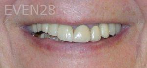 Sydon-Arroyo-Dental-Crown-before-2
