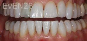 Sydon-Arroyo-Invisalign-Clear-Aligners-after-1