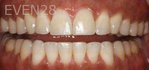 Sydon-Arroyo-Invisalign-Clear-Aligners-after-2