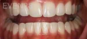 Sydon-Arroyo-Invisalign-Clear-Aligners-after-3