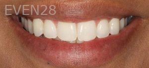 Sydon-Arroyo-Invisalign-Clear-Aligners-after-4