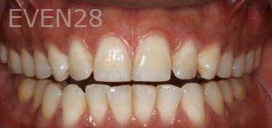 Sydon-Arroyo-Invisalign-Clear-Aligners-before-2