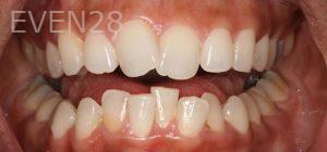 Sydon-Arroyo-Invisalign-Clear-Aligners-before-3