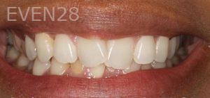 Sydon-Arroyo-Invisalign-Clear-Aligners-before-4