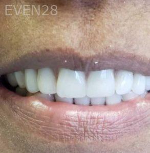 Vadim-Konviser-All-on-Four-Dental-Implants-after-1b