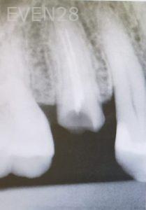 Vadim-Konviser-Dental-Implants-before-1