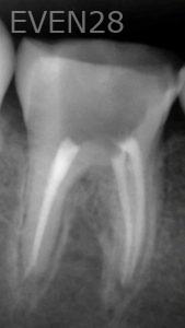Vadim-Konviser-Root-Canal-Treatment-after-1