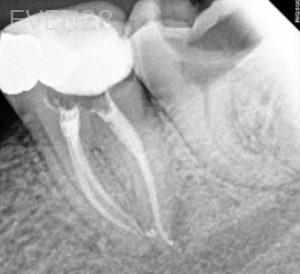 Vadim-Konviser-Root-Canal-Treatment-after-2