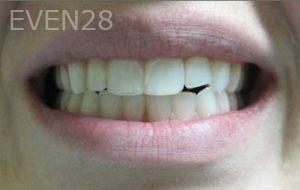 Varand-Kerikorian-Dental-Bonding-before-1