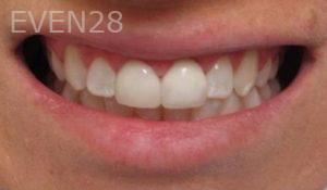 Varand-Kerikorian-Dental-Crowns-after-1