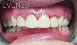 Varand-Kerikorian-Dental-Crowns-after-2