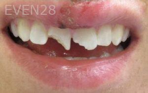 Varand-Kerikorian-Dental-Crowns-before-1