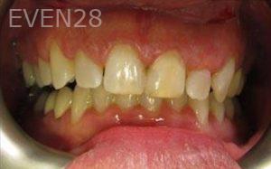 Varand-Kerikorian-Dental-Crowns-before-2