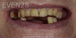 Victor-Khatchaturian-Full-Mouth-Rehabilitation-before-2