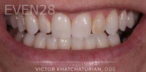 Victor-Khatchaturian-Porcelain-Veneers-before-2
