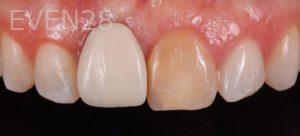 Yan-Fisher-Dental-Crowns-before-1