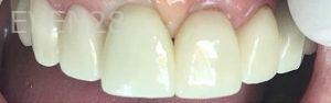 Yosi-Behroozan-Dental-Crowns-after-2