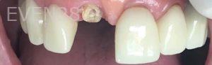 Yosi-Behroozan-Dental-Crowns-before-2