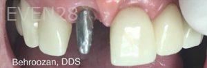 Yosi-Behroozan-Dental-Crowns-before-2b