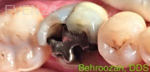 Yosi-Behroozan-Dental-Crowns-before-5