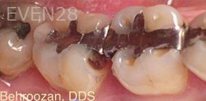 Yosi-Behroozan-Dental-Crowns-before-6