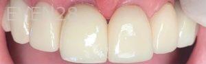 Yosi-Behroozan-Dental-Implants-after-1