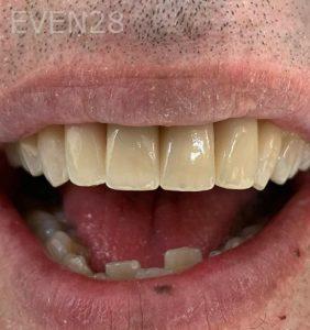 Yosi-Behroozan-Dental-Implants-after-2