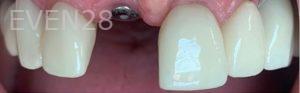Yosi-Behroozan-Dental-Implants-before-1