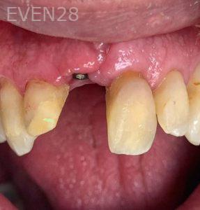 Yosi-Behroozan-Dental-Implants-before-2
