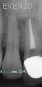 Yosi-Behroozan-Root-Canal-Treatment-after-1