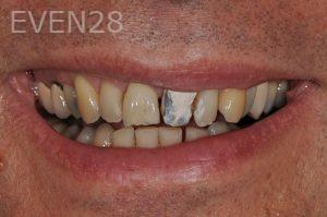 Aria-Irvani-dental-crowns-before-1