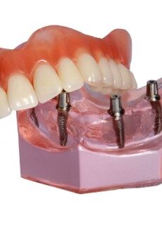 snap-on-denture-4-implants